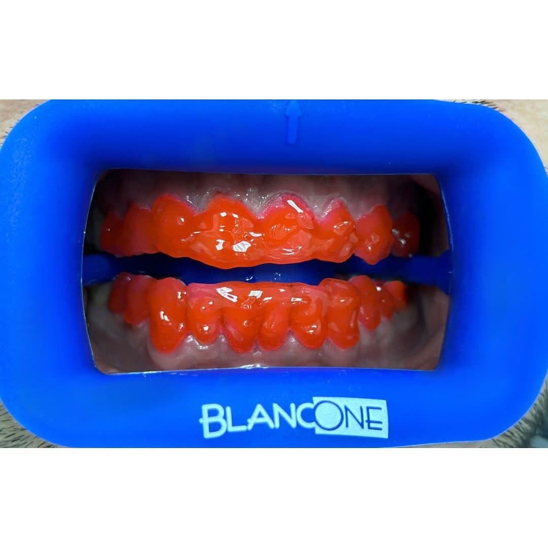 Rezultat albire BlancOne Mazur Dent