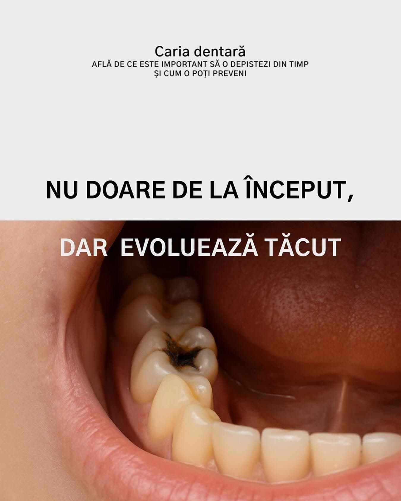 Caria dentară pe molar — depistare timpurie — Mazur Dent