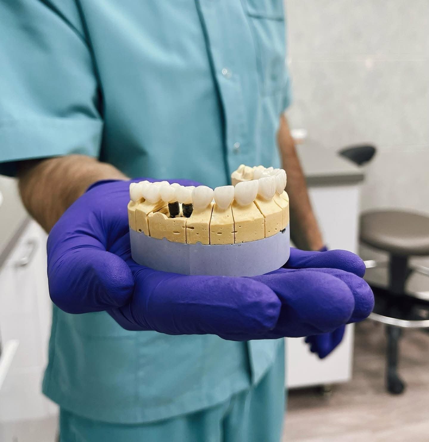 Coroane zirconiu pe model — laborator Mazur Dent Chișinău