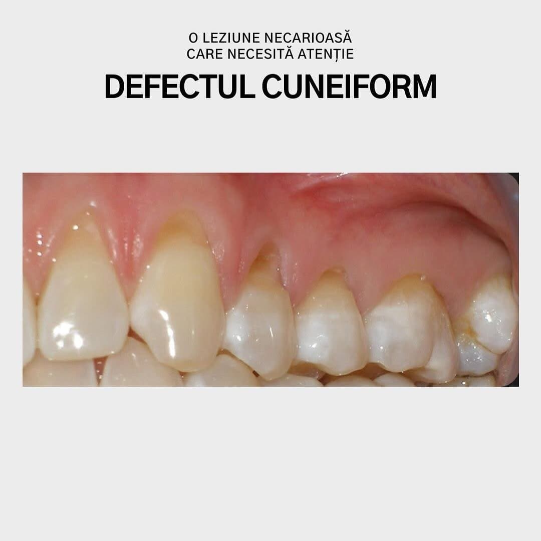 Defectul cuneiform la dinții frontali superiori — Mazur Dent