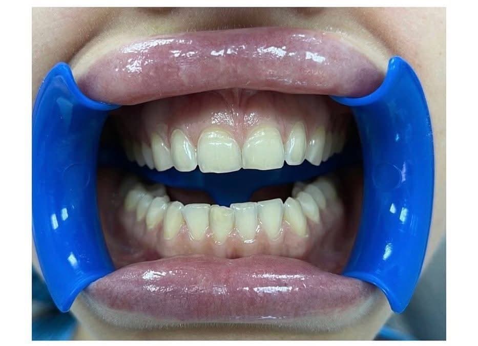 Pregătire pentru fațete dentare — Mazur Dent Chișinău