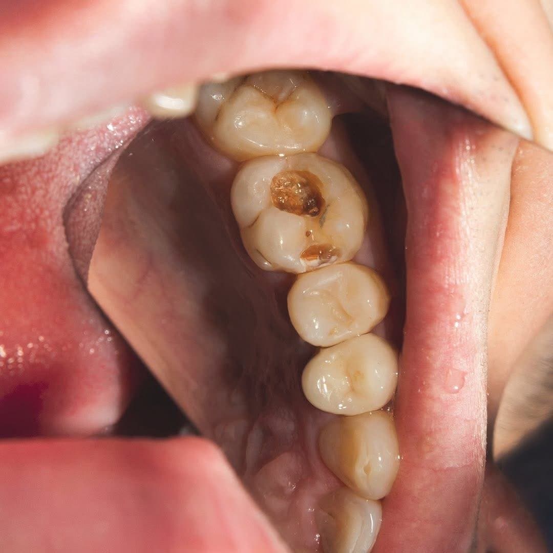 Caz clinic carie profundă — necesită tratament endodontic — Mazur Dent